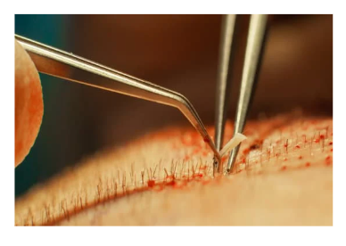 Hair Transplant Cost: What to Expect vs. Valoris Lab