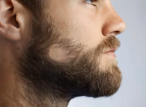 Alopecia de la barba