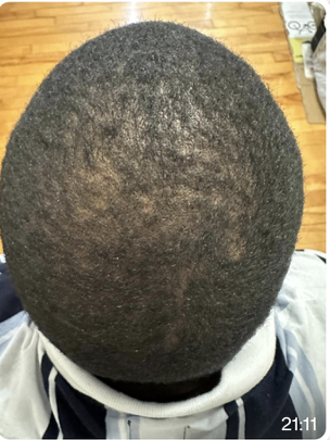 Ulrich before hair treatment