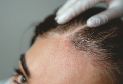 Early Hair Loss